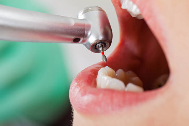 Best Emergency Treatment for Toothache in Difficult Run, VA